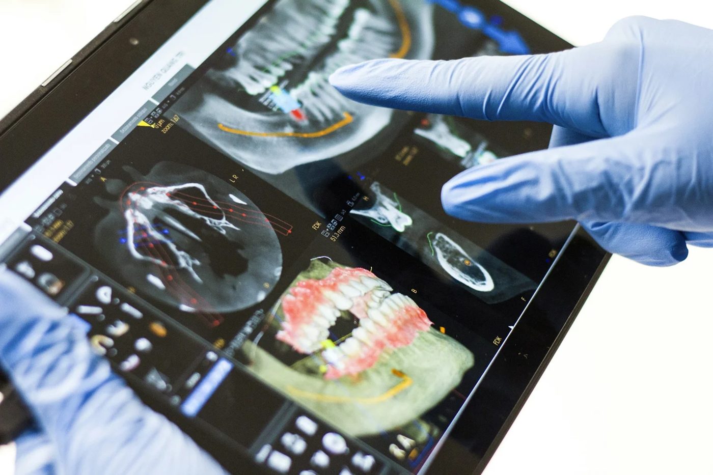 A dentist reviewing a 3D dental scan for implant planning at Dentist In The Park