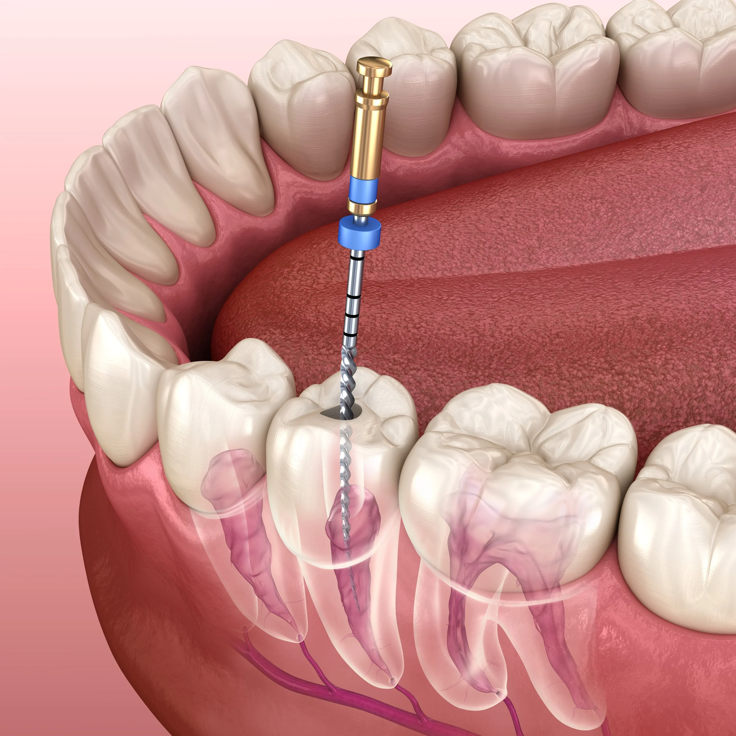 A 3D illustration of a root canal file cleaning the canals inside a molar