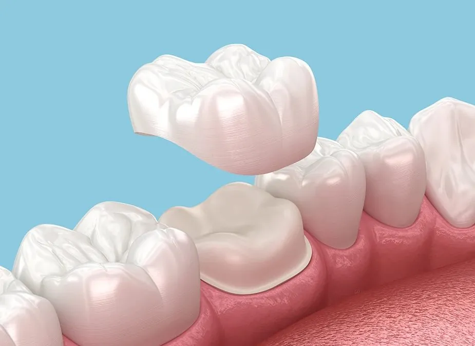Same-Day Crowns in Bondi Junction — How CEREC Works and Who It Suits