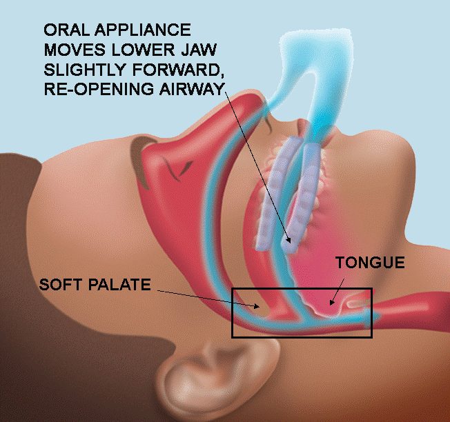 A diagram showing how a dental sleep appliance moves the lower jaw forward to open the airway