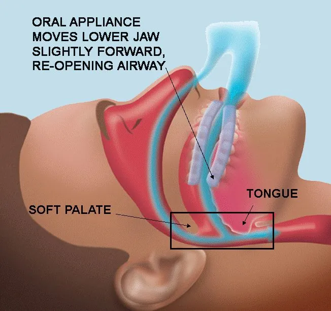 A diagram showing how a dental sleep appliance moves the lower jaw forward to open the airway
