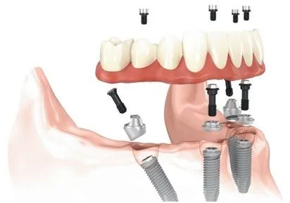 Replacing Missing Teeth in Bondi Junction — Dental Implants, Bridges and All-on-4
