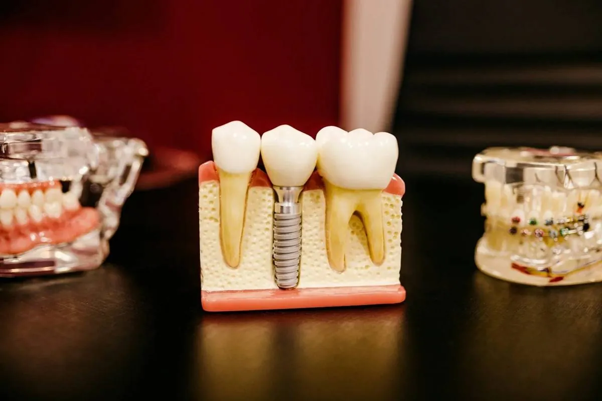 A dental model showing a dental implant between natural teeth