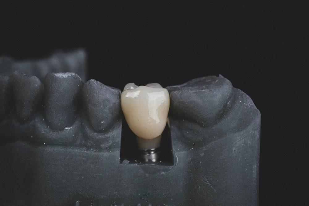 Replacing Missing Teeth in Bondi Junction — Dental Implants, Bridges and All-on-4