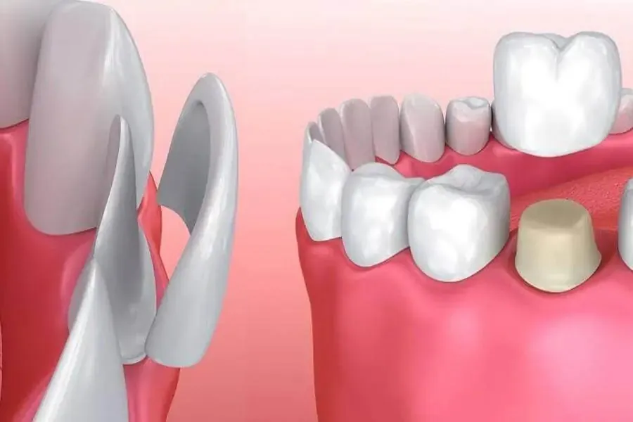 Dental Veneers in Bondi Junction — Porcelain and Composite Options Explained